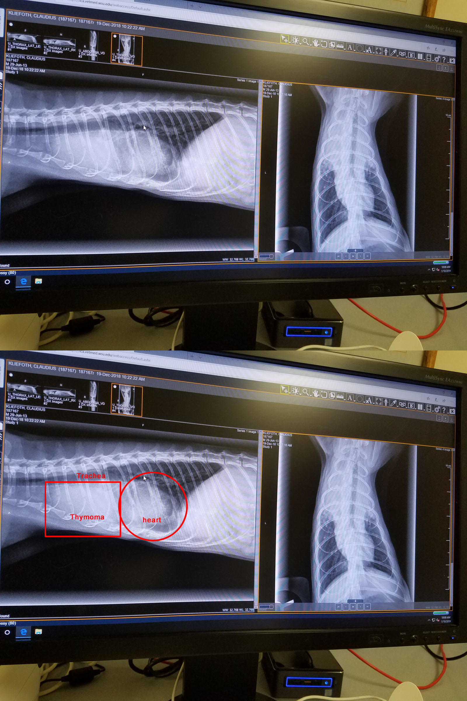 X-ray of Claudius, showing his torso and the thymoma tumor.